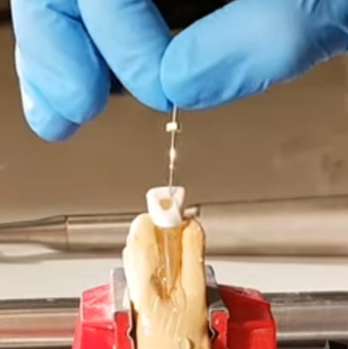 root canal treatment